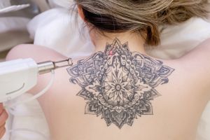 tattoo removal clinics adelaide Laser You