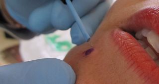 mole removal clinics adelaide Skin Doctor SA