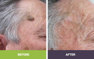 mole removal clinics adelaide Skin Doctor SA