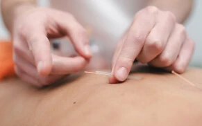 Patient undergoing dry needling therapy on back.