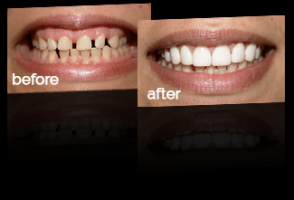 porcelain veneers before and after